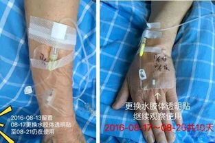 狗狗留置针堵塞怎么办