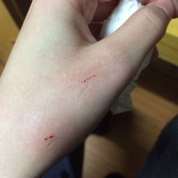 猫抓伤打疫苗管多长时间