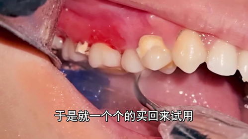 狗狗牙结石清理一次多少钱