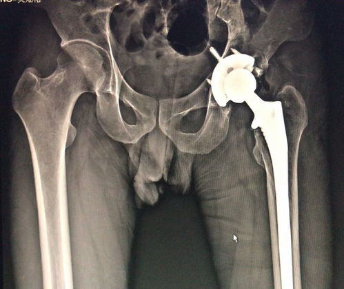 狗髋关节脱位治疗费用