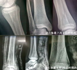 宠物狗腓骨骨折怎么办啊