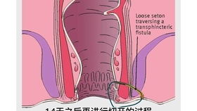 宠物狗得肛瘘怎么治疗好