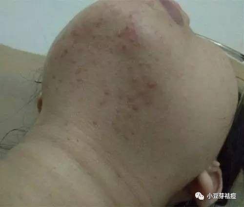 宠物狗脖子长痘痘怎么办