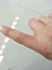 宠物狗划到手指怎么办
