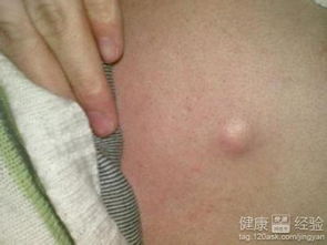 宠物狗脂肪瘤怎么治