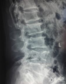 宠物狗腰椎骨折怎么办啊