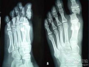 宠物狗趾骨骨折怎么办啊